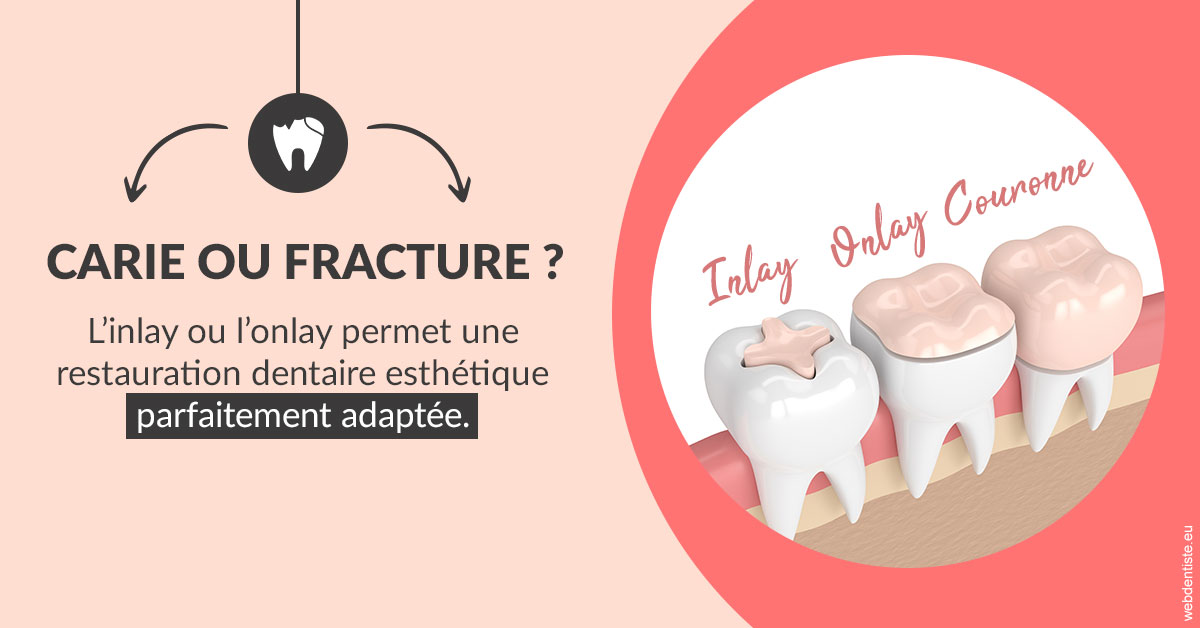 https://dr-potard-marie.chirurgiens-dentistes.fr/T2 2023 - Carie ou fracture 2