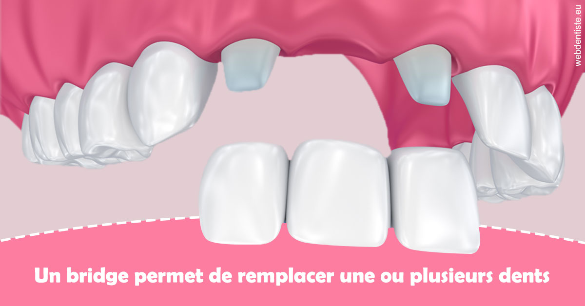 https://dr-potard-marie.chirurgiens-dentistes.fr/Bridge remplacer dents 2