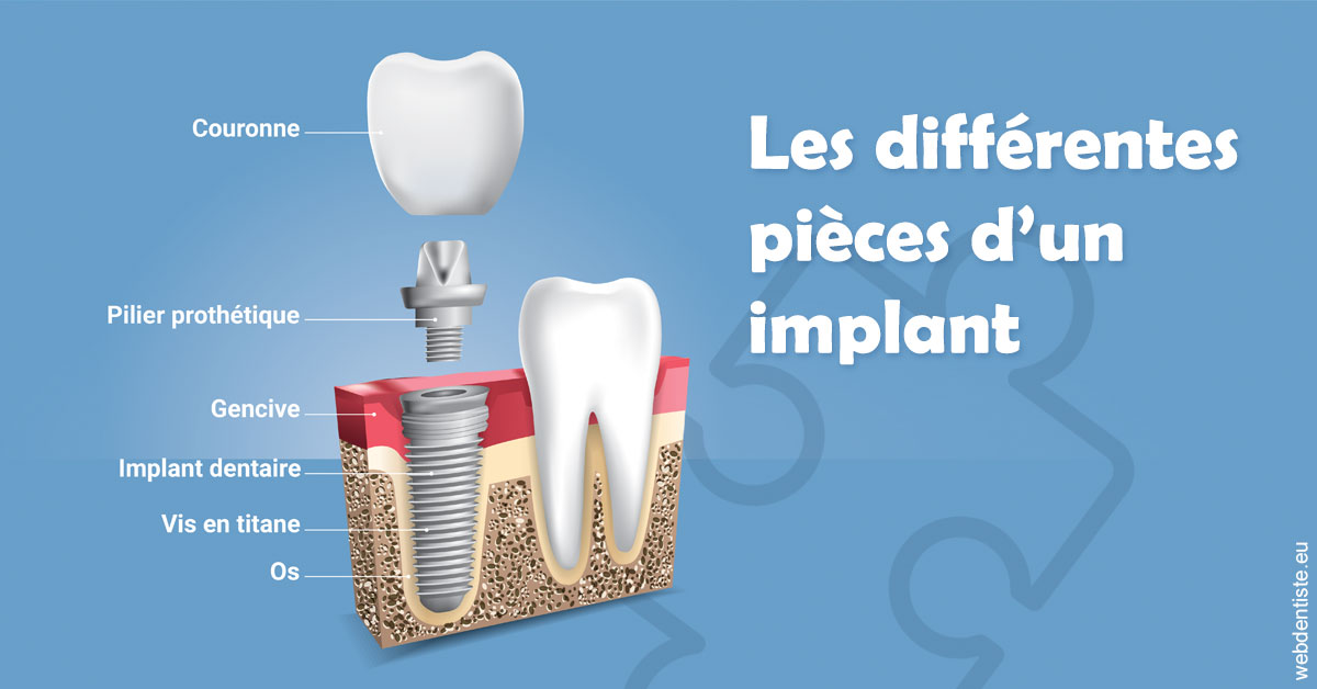 https://dr-potard-marie.chirurgiens-dentistes.fr/Les différentes pièces d’un implant 1